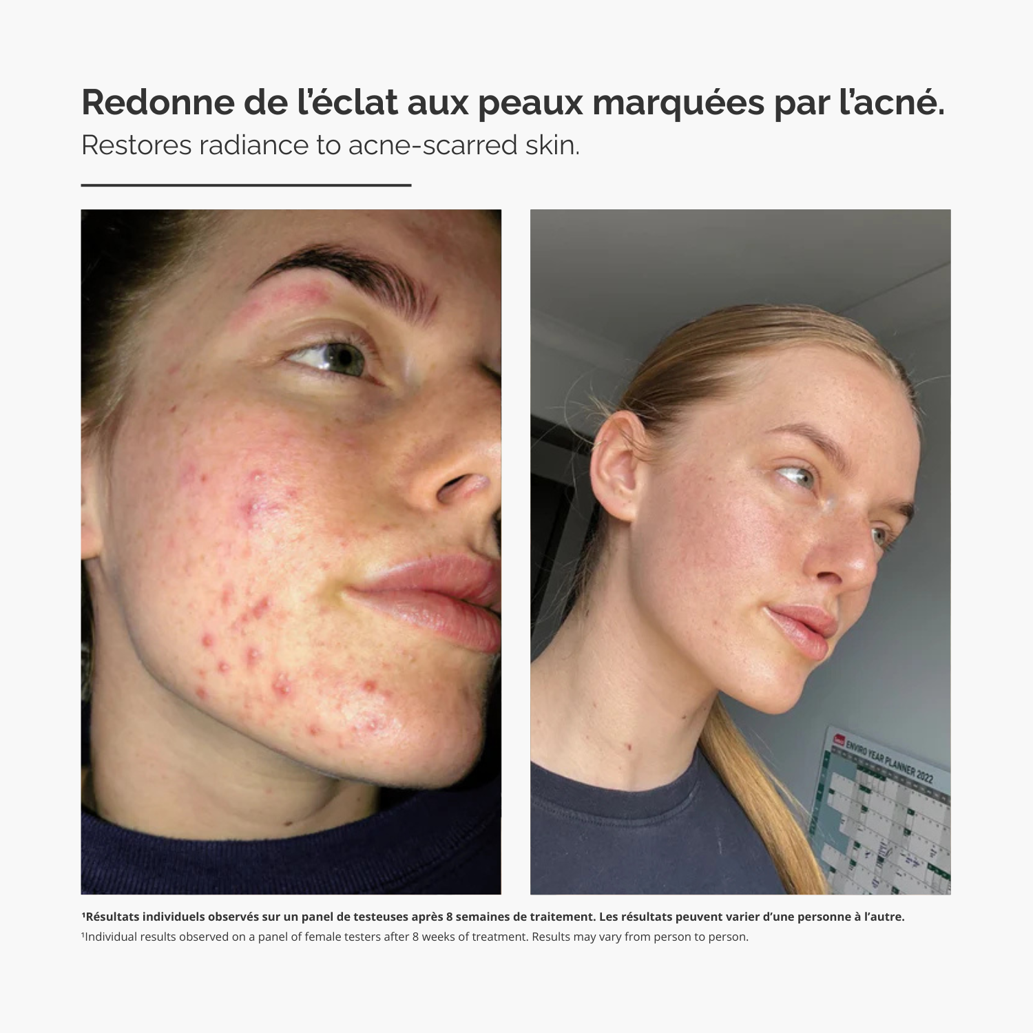 Système de Micro-Infusion™ – Sérum Anti-Acné Avancé