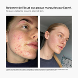 Système de Micro-Infusion™ – Sérum Anti-Acné Avancé