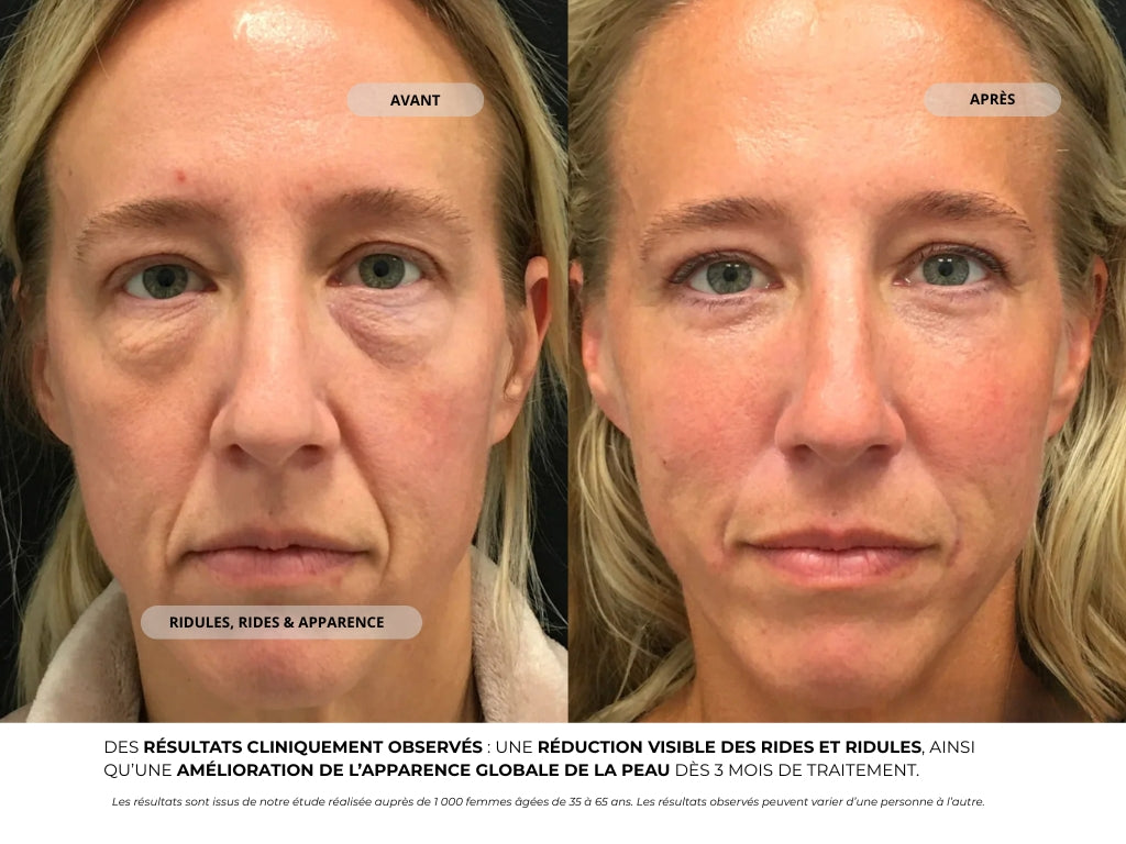Système de Micro-Infusion - Novaé™
