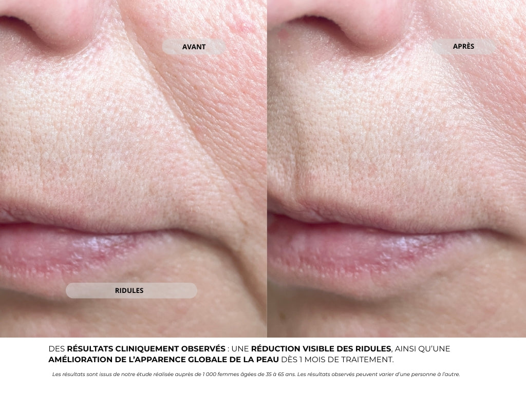 Système de Micro-Infusion - Novaé™
