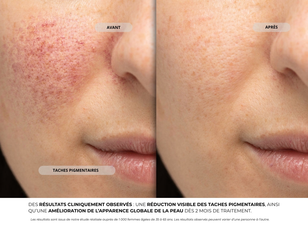 Système de Micro-Infusion - Novaé™