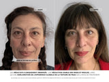 Système de Micro-Infusion - Novaé™