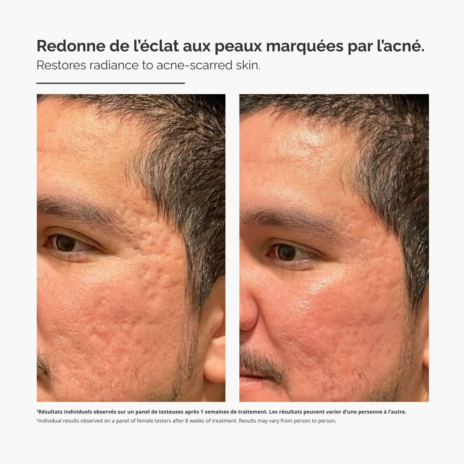 Système de Micro-Infusion™ – Sérum Anti-Acné Avancé